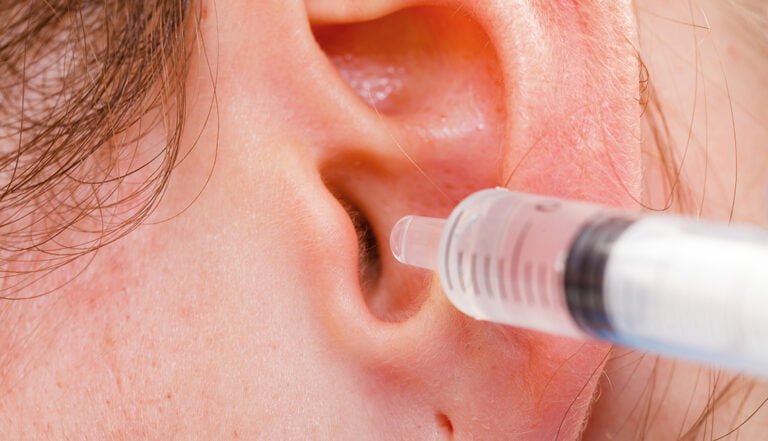 Cómo quitar un tapón de cera del oído sin ir al médico