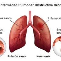 2864024-enfermedad-pulmonar-obstructiva-cronica