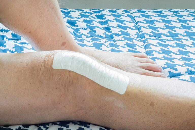 Cómo curar una herida de levantamiento de piel