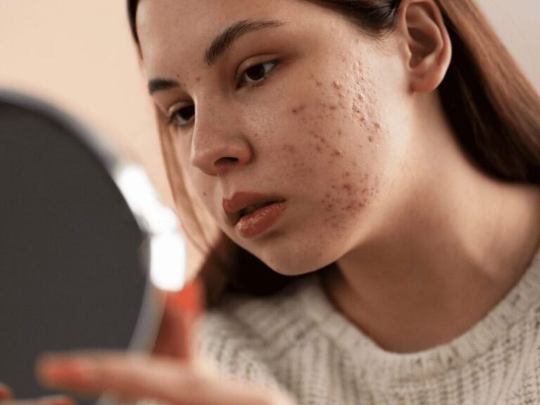 Cómo eliminar rápidamente el acné juvenil Consejos efectivos