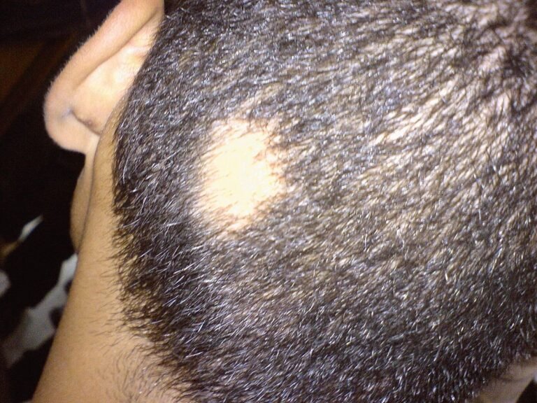 La alopecia areata puede curarse sola Descúbrelo aquí