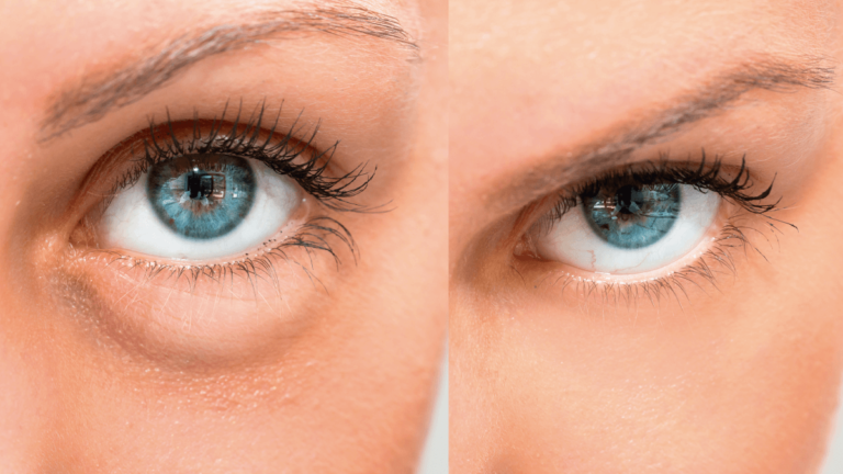 Cuál es el Mejor Aceite Antiinflamatorio para Bolsas en los Ojos