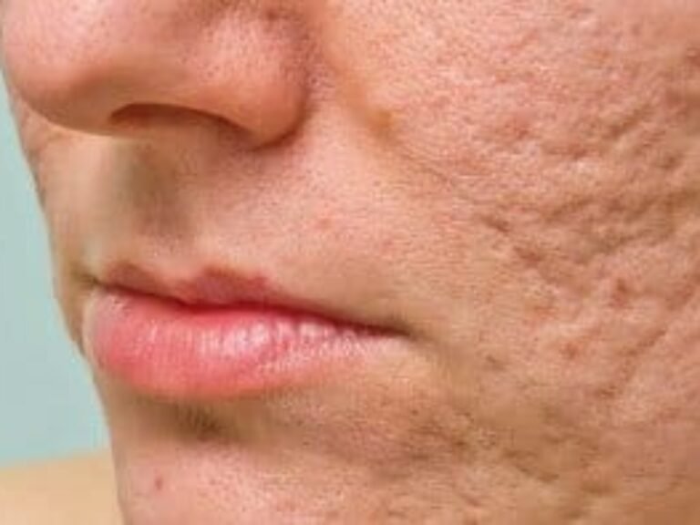 Cómo eliminar cicatrices del rostro eficazmente