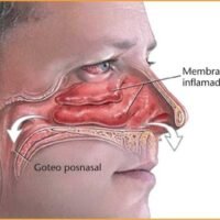 congestion-nasal