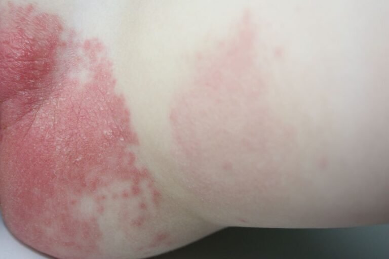 Cómo se ve la dermatitis por pañal