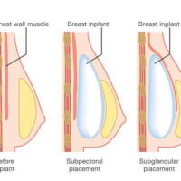 insercion-de-implantes-mamarios