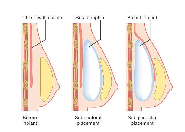 Cómo puedo agrandar mis senos de forma no invasiva