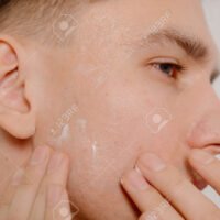 joven-aplicando-tratamiento-facial-para-acne