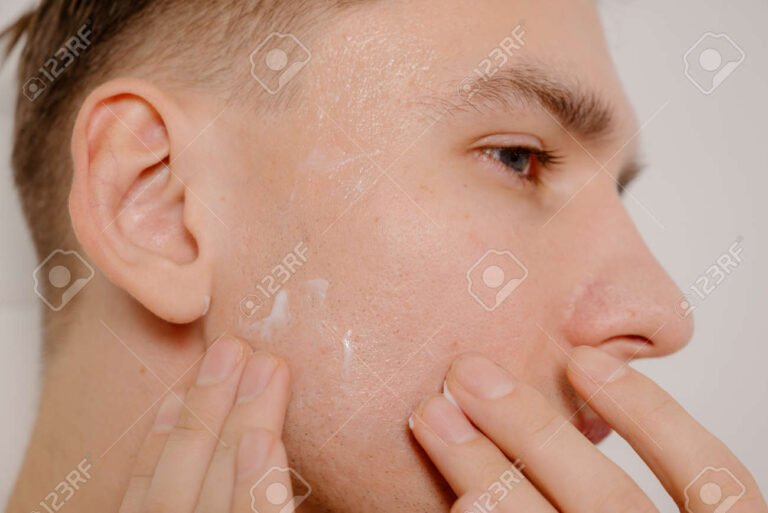 Cómo eliminar las manchas negras en la cara por acné