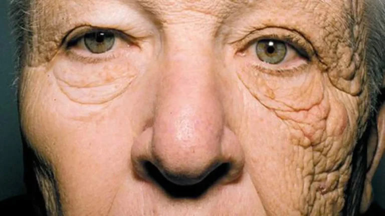 Efectos de los rayos UV en la piel: daños y prevención