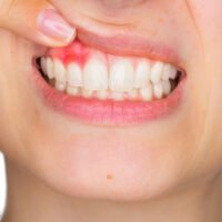problemas-encias-gingivitis-periodontitis