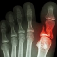 radiografia-de-fractura-del-dedo-gordo-pie