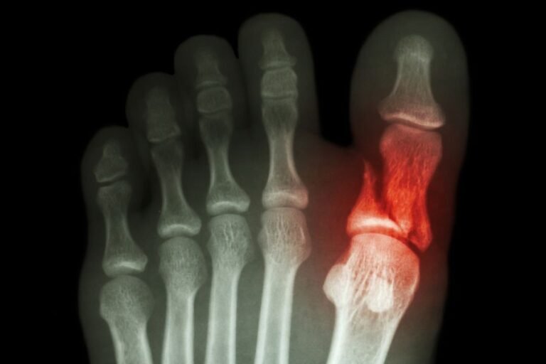 Cómo tratar una fractura del dedo gordo del pie