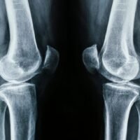 radiografia-de-rodilla-tecnica-y-resultados