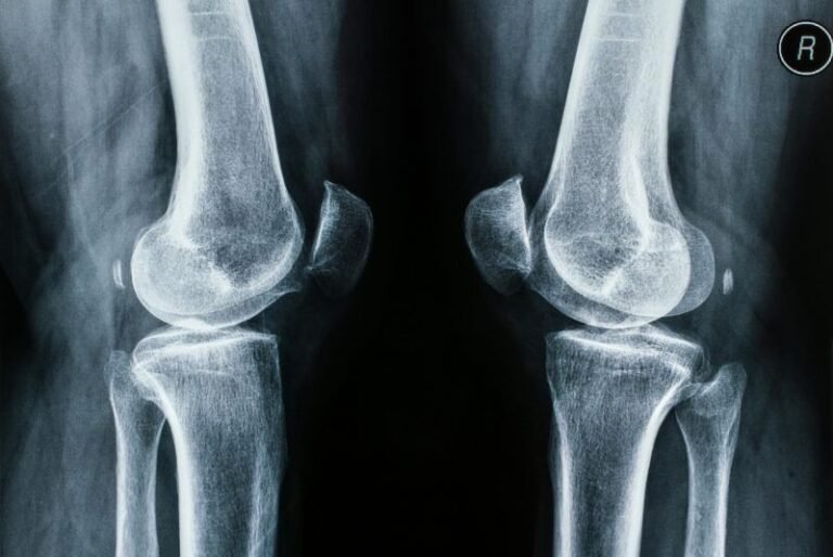 Cómo se realiza una radiografía de rodilla AP y lateral comparativo