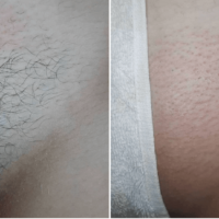 resultado-de-depilacion-brasilena-antes-y-despues
