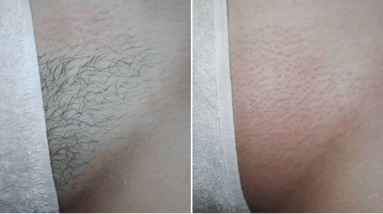 Cómo es la depilación brasileña antes y después
