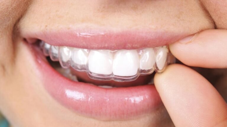 Cómo enderezar los dientes sin usar brackets: Métodos efectivos