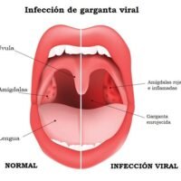 tratamiento-amigdalitis-viral_strefen