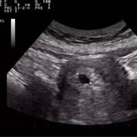ultrasonido-del-embrion-en-desarrollo-temprano