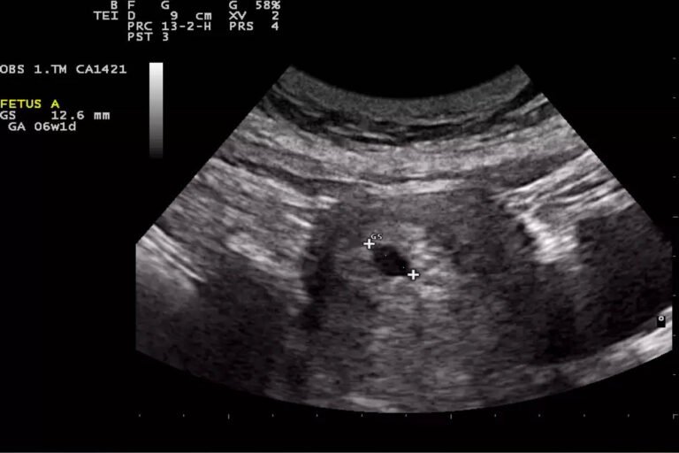 Cuáles son las etapas del embarazo en el primer trimestre
